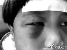 6月2日，網(wǎng)曝渭南市臨渭區(qū)一不滿5歲的女童遭奶奶毆打，眼圈青腫，引起網(wǎng)友關(guān)注，但孩子父母和爺爺均稱是摔倒導(dǎo)致。相關(guān)部門(mén)介入調(diào)查發(fā)現(xiàn)確為奶奶毆打所致，鑒于其身體原因已進(jìn)行批評(píng)教育。