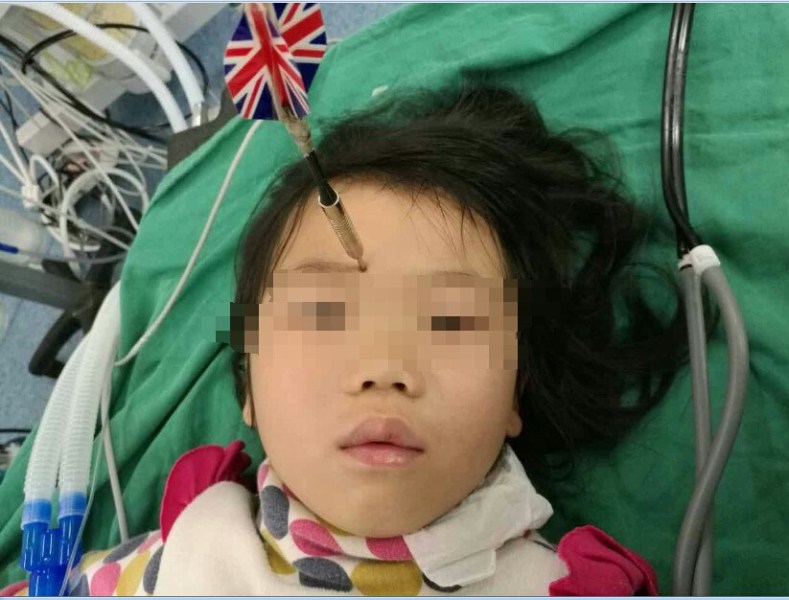 十多公分長(zhǎng)的飛鏢穩(wěn)穩(wěn)地 ” 定 ” 在了一名六歲半的女童額頭上，小青一家人凌晨從長(zhǎng)順趕到貴醫(yī)附院急診室時(shí)，看到如此慘烈的情況，接診醫(yī)生都嚇了一跳。詳細(xì)詢問(wèn)下得知，原來(lái)是七歲的哥哥和六歲半的表妹在玩耍時(shí)，哥哥不慎將路邊撿來(lái)的真飛鏢扎到了妹妹的額頭上。
