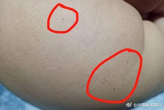 據(jù)多名紅黃藍(lán)(新天地分園)家長(zhǎng)反映，孩子腿部、屁股、腋下出現(xiàn)針眼。