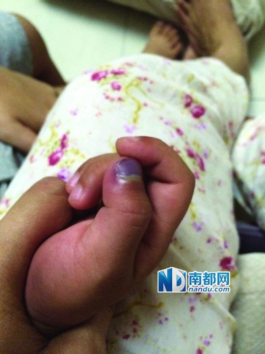 小逸手指被夾傷。
