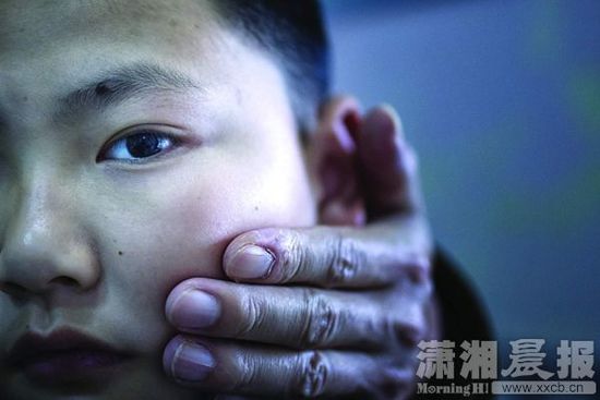 1月13日，小玨的父親心疼地摸著兒子的臉。