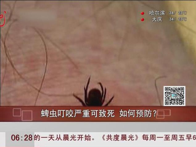 蜱蟲叮咬嚴(yán)重可致死如何預(yù)防？
